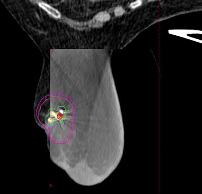 Feasibility and Short-Term Toxicity of a Consecutively Delivered Five Fraction Stereotactic Body Radiation Therapy Regimen in Early-Stage Breast Cancer Patients Receiving Partial Breast Irradiation